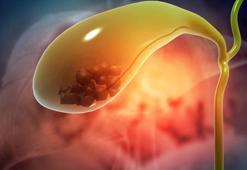 Uzmanı uyardı: İdrar rengi, o hastalığın habercisi olabilir