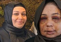 Boşanma aşamasındaki eşi ‘güzelliğini elinden alacağım’ deyip yüzünü parçaladı! EGM’den flaş açıklama