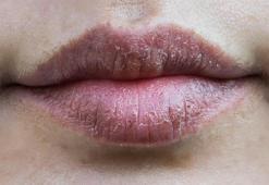 Kış aylarının can yakan sorunu! 1 damlası yetiyor, dudakları pamuk gibi yapıyor