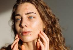 Akne, ‘nasılsa geçer’ deyip ihmal ediliyor! Geciken tedavi yüzde kalıcı izler bırakıyor