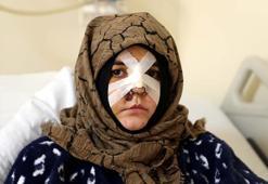 Eşinin kaldırım taşı ile dövdüğü Nazlı: Ayaklarım üzerinde dursaydım o adama dönmezdim