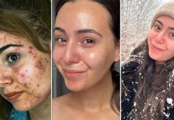 İrin akan sivilcelerinden kurtuldu! Çözümü çok basit: 'İçeriği bu asitle dolu'