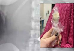 Yoğurt yerken bir anda oldu, söylemeye dahi utandı! Tam 17 santimetre büyüklüğünde, 2 gün vücudunda kaldı