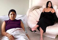 Lazer epilasyon faciası! Ateşlendi, ameliyat oldu: 20 gün hastanede yattım