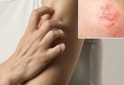 Sessiz başlayan hastalık: Zona! 72 saat içinde tedaviye başlanmalı