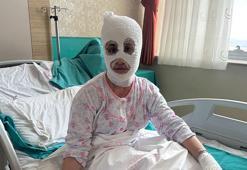 İftar vakti düdüklü tencere faciası! ‘Yüzüme elimi sürdüm, et parçası geliyordu'