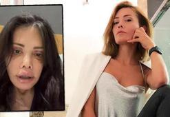 Didem Ceran'dan şoke eden paylaşım: Yüzü nakledilen kişinin alnı kaşıma denk geldi!