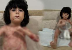 Yaraları tüm vücudunu sardı! 4 yıldır mücadele ediyor: Çaresiz durumda