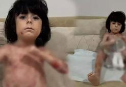 Yaraları tüm vücudunu sardı! 4 yıldır mücadele ediyor: Çaresiz durumda