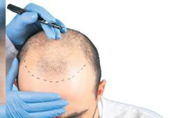 ‘Saç ekimi’ne vergi operasyonu