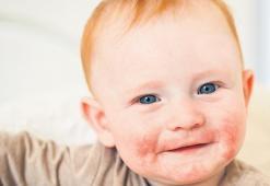 “Atopik dermatit” kaşıntının ötesinde bir hastalık