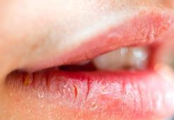 Ağız ve dudaktaki yaraları hafife almayın! Ciddi hastalıkların belirtisi olabilir