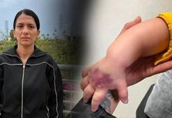 Doktor ‘bir şeyi yok’ dedi! Her şey morarmayla başladı: Çocuğumun kolu dirseğe kadar açıldı