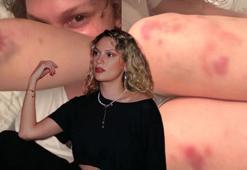 Farah Zeynep Abdullah’tan endişelendiren paylaşım! Vücudundaki morluklar korkuttu