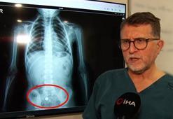 Parkta buldu, şeker diye yuttu! 4 yaşında çocuğu ölümden döndüren süreç röntgen filminde: Hareket halinde