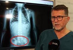Parkta buldu, şeker diye yuttu! 4 yaşında çocuğu ölümden döndüren süreç röntgen filminde: Hareket halinde