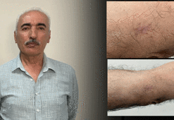 Kolundaki 1 santimetrelik yara aylarca geçmedi! Hastanede gerçeği öğrenince şoke oldu
