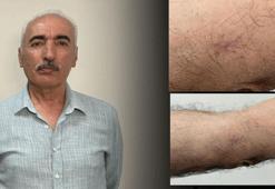 Kolundaki 1 santimetrelik yara aylarca geçmedi! Hastanede gerçeği öğrenince şoke oldu