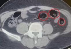 Yolcu otobüsünde şoke eden operasyon! Mide ve bağırsaklarından yarım kilo uyuşturucu çıktı