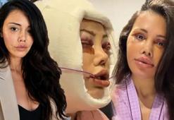 Didem Ceran 15 saatlik operasyonla yüz nakli olmuştu! Kendisini dünyaca ünlü yıldızla karşılaştırdı