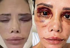 Yüz nakli olan Didem Ceran son halini paylaştı! 'Hepinizden çok özür diliyorum'