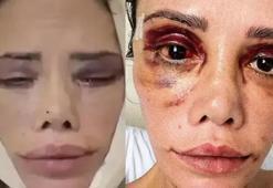 Yüz nakli olan Survivor Didem Ceran son halini paylaştı! 'Hepinizden çok özür diliyorum'