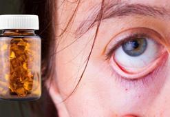 Göz altı morluğu hangi vitamin eksikliğinden kaynaklanır? Yorgunlukla birleşiyor
