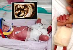 15 milyonda bir gerçekleşiyor: Tek yumurta dördüzleri! 'Kayıtlara geçen ilk vaka'