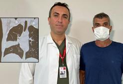 Hastanın akciğerinden kemik çıktı! 'Kemiği seven biriyim, şaşırtmadı'