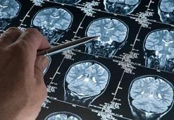 Her 3 saniyede bir kişi demans oluyor! Bakanlıktan Alzheimer uyarısı