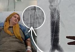 Milyonda bir görülen vaka! Öksürürken kalp damarı yırtılan kadın ölümden döndü