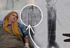 Milyonda bir görülen vaka! Öksürürken kalp damarı yırtılan kadın ölümden döndü
