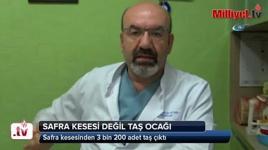 Safra kesesinden 3 bin 200 adet taş çıktı