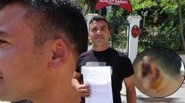 Kavgada kopan kulağını martı kaptı