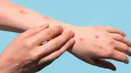 İstanbul'da maymun çiçeği hastalığı iddiası! Bakanlıktan açıklama geldi