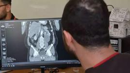 Karın şişliği için hastaneye gitti, böbreğinden 23 santimetrelik kist çıkarıldı