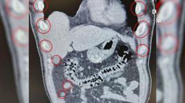 Mide ve bağırsaklarında uyuşturucu tespit edilen yabancı uyruklu 2 şüpheli tutuklandı