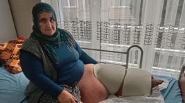 19 yaşında yakalandığı fil hastalığı nedeniyle 205 kiloya çıktı! 35 yıldır mücadele ediyor