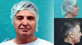 Devlet hastanesinde bir ilk! Yüz germe operasyonuna girdi, 15 yıl gençleşerek çıktı