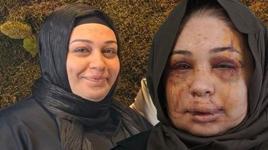 Boşanma aşamasındaki eşi ‘güzelliğini elinden alacağım’ deyip yüzünü parçaladı! EGM’den flaş açıklama