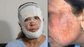 7 bin liralık ‘Prenses cilt bakımı’ kabusu: Oğlum beni görünce 'öcü' diyerek kaçtı