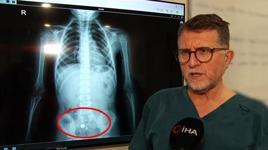 Parkta buldu, şeker diye yuttu! 4 yaşında çocuğu ölümden döndüren süreç röntgen filminde: Hareket halinde