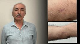 Kolundaki 1 santimetrelik yara aylarca geçmedi! Hastanede gerçeği öğrenince şoke oldu