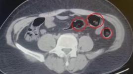 Yolcu otobüsünde şoke eden operasyon! Mide ve bağırsaklarından yarım kilo uyuşturucu çıktı
