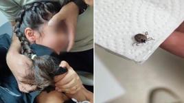 Bir aydır kulak ağrısı çekiyordu! Kulağında canlı kene bulundu