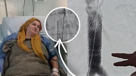 Milyonda bir görülen vaka! Öksürürken kalp damarı yırtılan kadın ölümden döndü