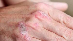 Sedef hastalığı erkek üreme sağlığını tehdit ediyor