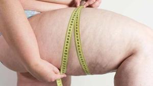 Lipodem nedir, nasıl tedavi edilir