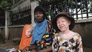 Afrikalı albinoların dramı sanatseverler ile buluşacak