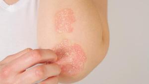 Mutlaka bilin: Sedef hastalığıyla ilgili en merak edilen detaylar